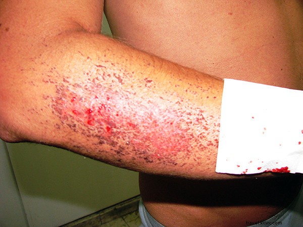 Mastering Travel Insurance: Lessons from 13 Years of Global Adventures